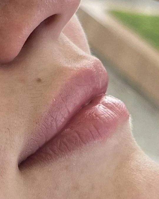 Preenchimento labial, antes
