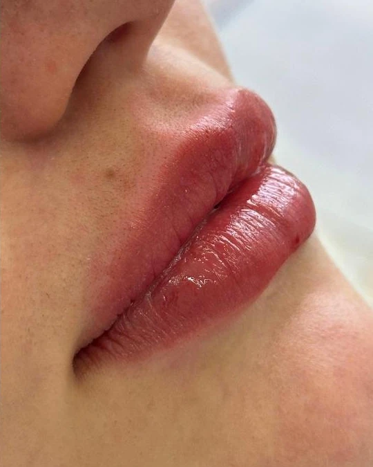 Preenchimento labial, depois